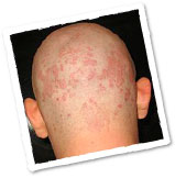 Seborrheic Dermatitis Symptoms